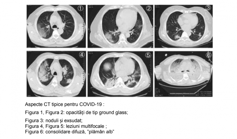 plămân afectat de COVID-19
