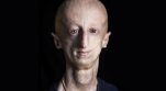 boala progeria