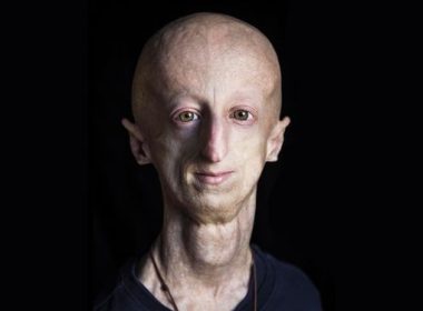 boala progeria