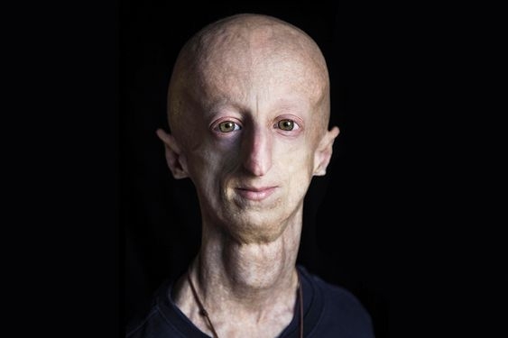 boala progeria